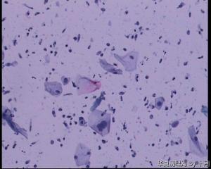 45岁，宫颈液基，后续会上传组织图片。图24