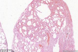 肺大疱组织，取材时未见到肺大疱图9