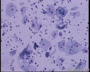 45岁，宫颈液基，后续会上传组织图片。图1