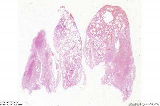 肺大疱组织，取材时未见到肺大疱图8