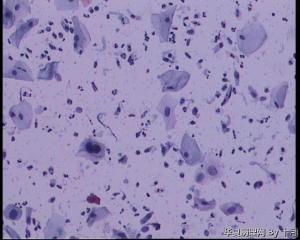 45岁，宫颈液基，后续会上传组织图片。图20