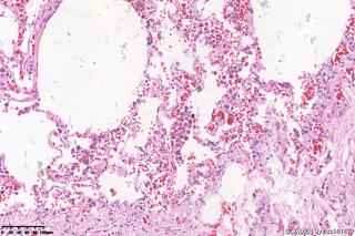 肺大疱组织，取材时未见到肺大疱图14
