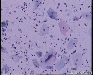 45岁，宫颈液基，后续会上传组织图片。图6