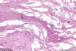 肺大疱组织，取材时未见到肺大疱图2