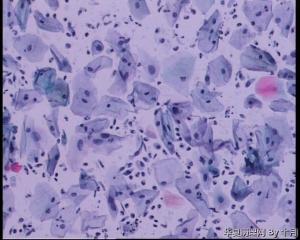 45岁，宫颈液基，后续会上传组织图片。图31