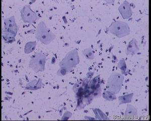 45岁，宫颈液基，后续会上传组织图片。图13
