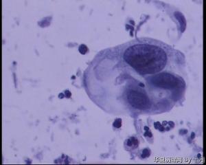 45岁，宫颈液基，后续会上传组织图片。图37