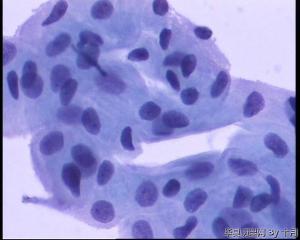 56岁，宫颈液基，较多的多核巨细胞什么意义呢？图2