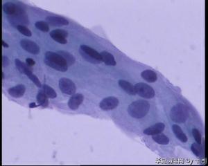 56岁，宫颈液基，较多的多核巨细胞什么意义呢？图3