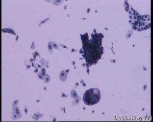 56岁，宫颈液基，较多的多核巨细胞什么意义呢？图12