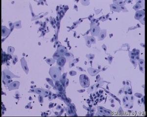 56岁，宫颈液基，较多的多核巨细胞什么意义呢？图8