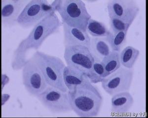56岁，宫颈液基，较多的多核巨细胞什么意义呢？图16