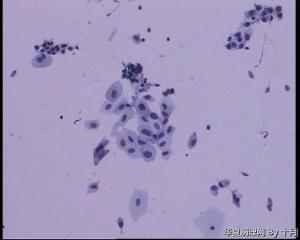 56岁，宫颈液基，较多的多核巨细胞什么意义呢？图15