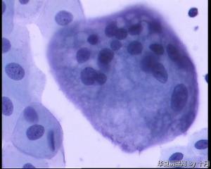 56岁，宫颈液基，较多的多核巨细胞什么意义呢？图5