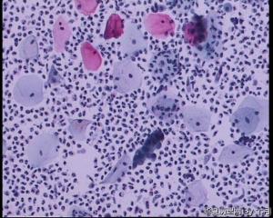 28岁，宫颈液基，腺细胞？有问题吗？图12