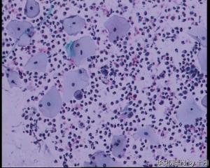 44岁，宫颈液基（以副基底细胞及中层细胞为主，故萎缩？）图9