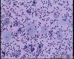 44岁，宫颈液基（以副基底细胞及中层细胞为主，故萎缩？）图1