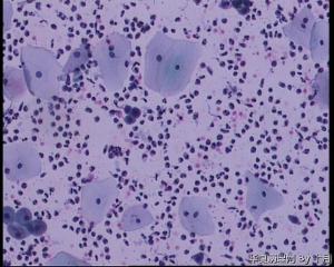44岁，宫颈液基（以副基底细胞及中层细胞为主，故萎缩？）图11