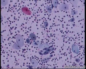 44岁，宫颈液基（以副基底细胞及中层细胞为主，故萎缩？）图13