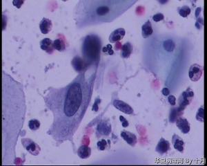 44岁，宫颈液基（以副基底细胞及中层细胞为主，故萎缩？）图18