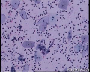 44岁，宫颈液基（以副基底细胞及中层细胞为主，故萎缩？）图20