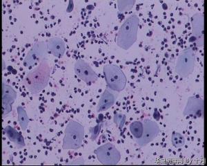 44岁，宫颈液基（以副基底细胞及中层细胞为主，故萎缩？）图17