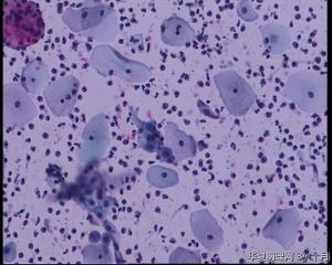 44岁，宫颈液基（以副基底细胞及中层细胞为主，故萎缩？）图25