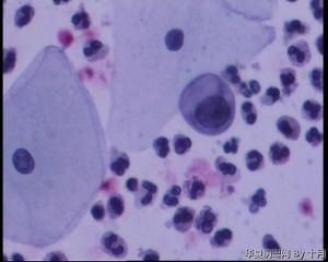 44岁，宫颈液基（以副基底细胞及中层细胞为主，故萎缩？）图10