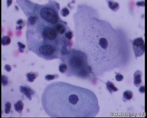 44岁，宫颈液基（以副基底细胞及中层细胞为主，故萎缩？）图26