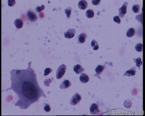 44岁，宫颈液基（以副基底细胞及中层细胞为主，故萎缩？）图24