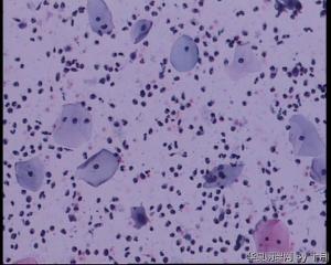 44岁，宫颈液基（以副基底细胞及中层细胞为主，故萎缩？）图23