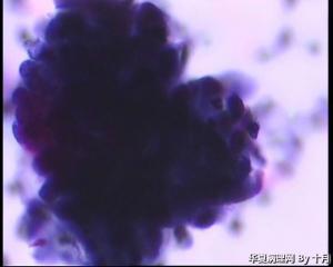 44岁，宫颈液基（以副基底细胞及中层细胞为主，故萎缩？）图8