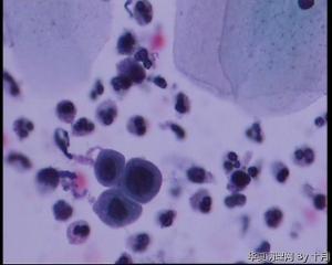 44岁，宫颈液基（以副基底细胞及中层细胞为主，故萎缩？）图12