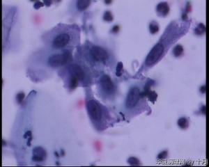 44岁，宫颈液基（以副基底细胞及中层细胞为主，故萎缩？）图21