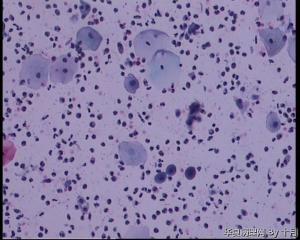 44岁，宫颈液基（以副基底细胞及中层细胞为主，故萎缩？）图15