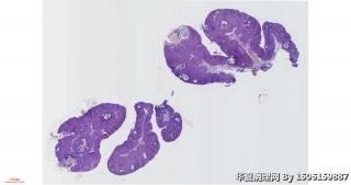 左下睑新生物图1