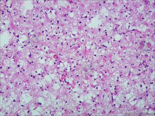 纤维型星形细胞瘤OR肥胖型星形细胞瘤图1