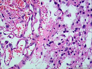 纤维型星形细胞瘤OR肥胖型星形细胞瘤图11