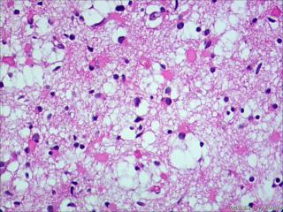 纤维型星形细胞瘤OR肥胖型星形细胞瘤图12