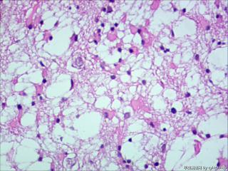纤维型星形细胞瘤OR肥胖型星形细胞瘤图9