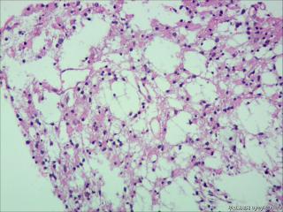 纤维型星形细胞瘤OR肥胖型星形细胞瘤图19