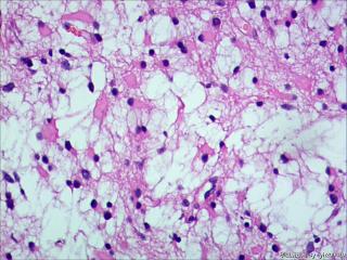 纤维型星形细胞瘤OR肥胖型星形细胞瘤图7