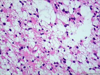 纤维型星形细胞瘤OR肥胖型星形细胞瘤图13