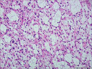 纤维型星形细胞瘤OR肥胖型星形细胞瘤图4