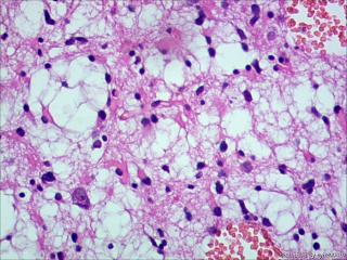 纤维型星形细胞瘤OR肥胖型星形细胞瘤图8