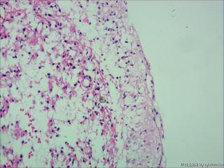 纤维型星形细胞瘤OR肥胖型星形细胞瘤图16