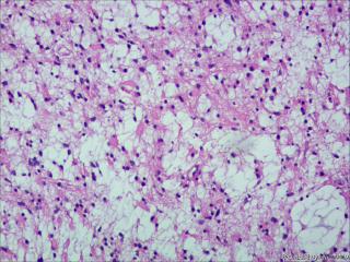 纤维型星形细胞瘤OR肥胖型星形细胞瘤图6