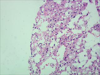 纤维型星形细胞瘤OR肥胖型星形细胞瘤图18