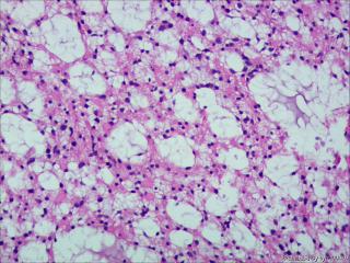 纤维型星形细胞瘤OR肥胖型星形细胞瘤图3