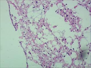 纤维型星形细胞瘤OR肥胖型星形细胞瘤图17